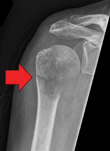 image of a shoulder x-ray with a red arrow pointing to a dark line near the top of the humerus